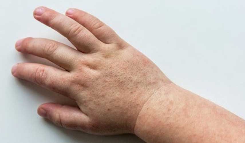 Çocuklarda Kızıl Hastalığı